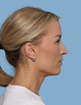 Blepharoplasty after - side right