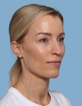 Blepharoplasty before - oblique right