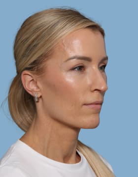 Blepharoplasty after - oblique right