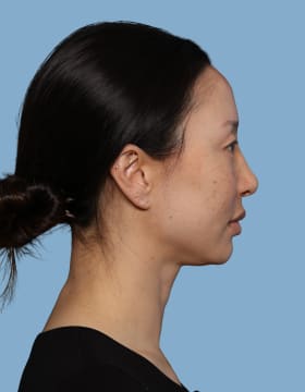 Blepharoplasty before - side right