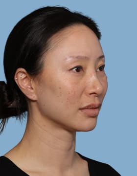 Blepharoplasty before - oblique right