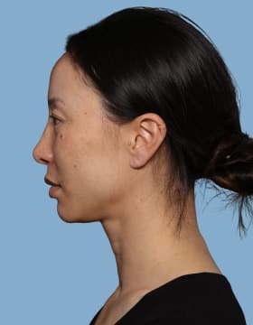 Blepharoplasty before - side left
