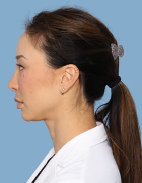 Blepharoplasty after - side left