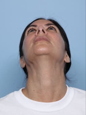 Rhinoplasty after - under