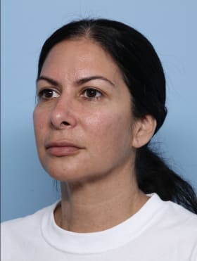 Rhinoplasty after - oblique left