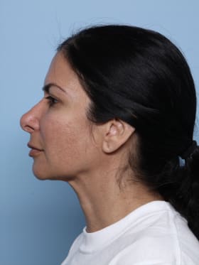 Rhinoplasty after - side left