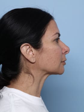 Rhinoplasty after - side right