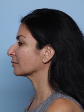 Rhinoplasty after - front view