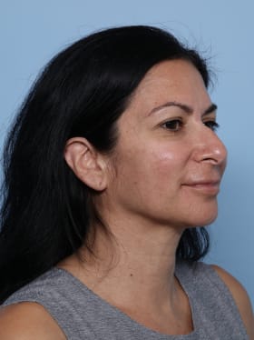 Rhinoplasty before - oblique right