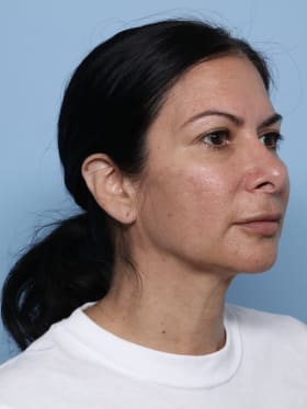 Rhinoplasty after - oblique right