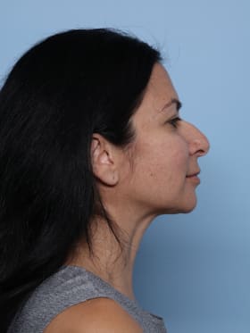 Rhinoplasty before - side right