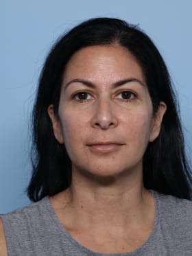 Rhinoplasty before - front view