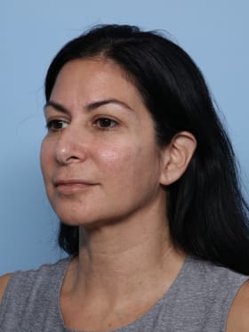 Rhinoplasty before - oblique left