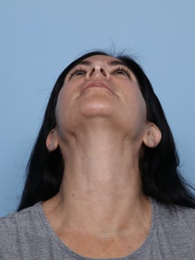 Rhinoplasty before - under