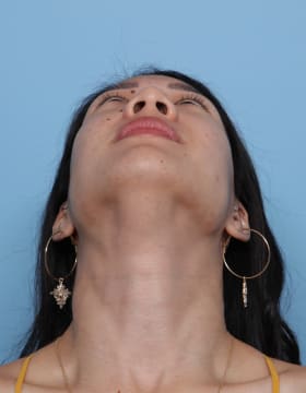 Rhinoplasty before - under