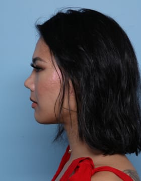 Rhinoplasty after - side left