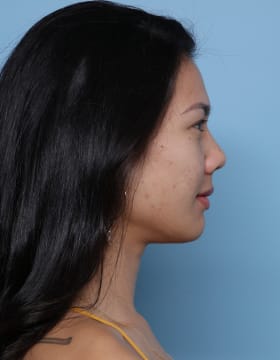 Rhinoplasty before - side right
