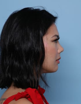 Rhinoplasty after - side right