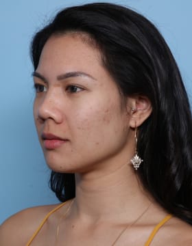 Rhinoplasty before - oblique left