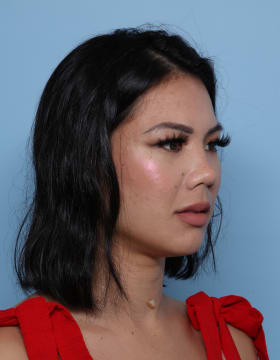 Rhinoplasty after - oblique right