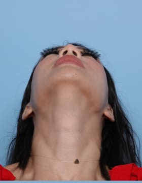 Rhinoplasty after - under