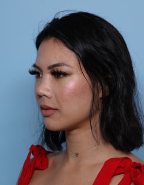 Rhinoplasty after - oblique left