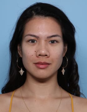 Rhinoplasty before - front view
