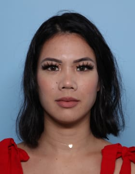 Rhinoplasty after - front view