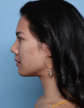 Rhinoplasty before - side left