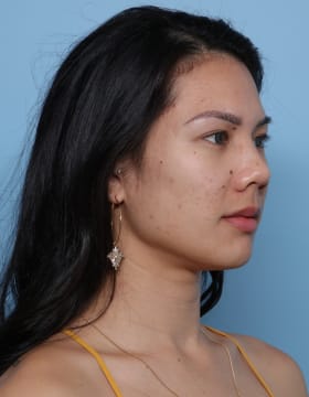 Rhinoplasty before - oblique right