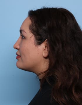 Rhinoplasty before - side left