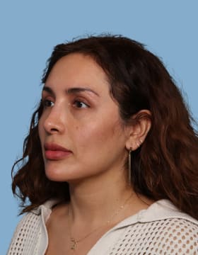 Rhinoplasty after - oblique left