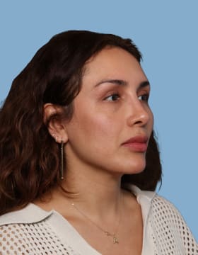 Rhinoplasty after - oblique right