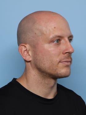 Rhinoplasty after - oblique right