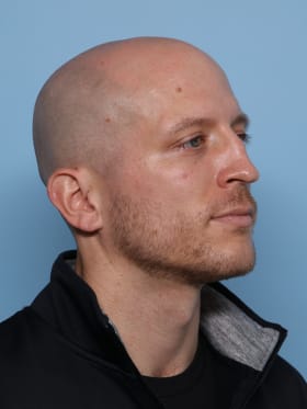 Rhinoplasty before - oblique right