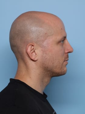 Rhinoplasty after - side right