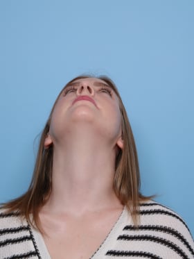 Rhinoplasty before - under