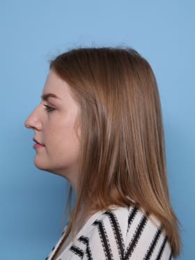 Rhinoplasty before - side left