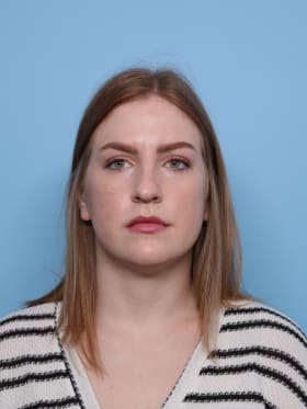 Rhinoplasty before - front view