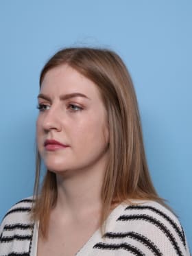 Rhinoplasty before - oblique left