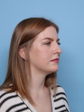 Rhinoplasty before - oblique right