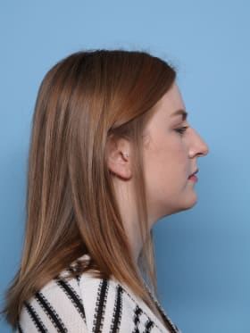 Rhinoplasty before - side right