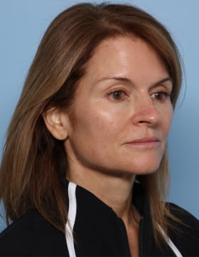 Rhinoplasty before - oblique right