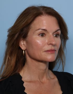 Rhinoplasty after - oblique right