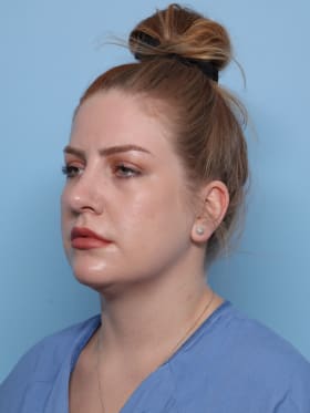 Rhinoplasty after - oblique left