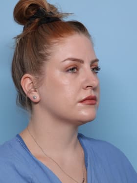 Rhinoplasty after - oblique right