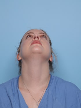 Rhinoplasty after - under