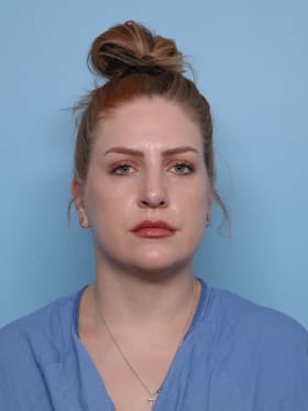 Rhinoplasty after - front view