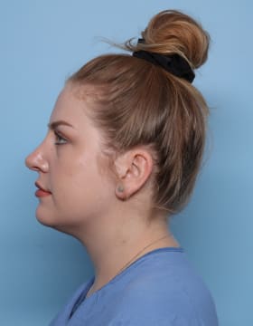 Rhinoplasty after - side left