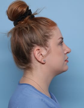 Rhinoplasty after - side right